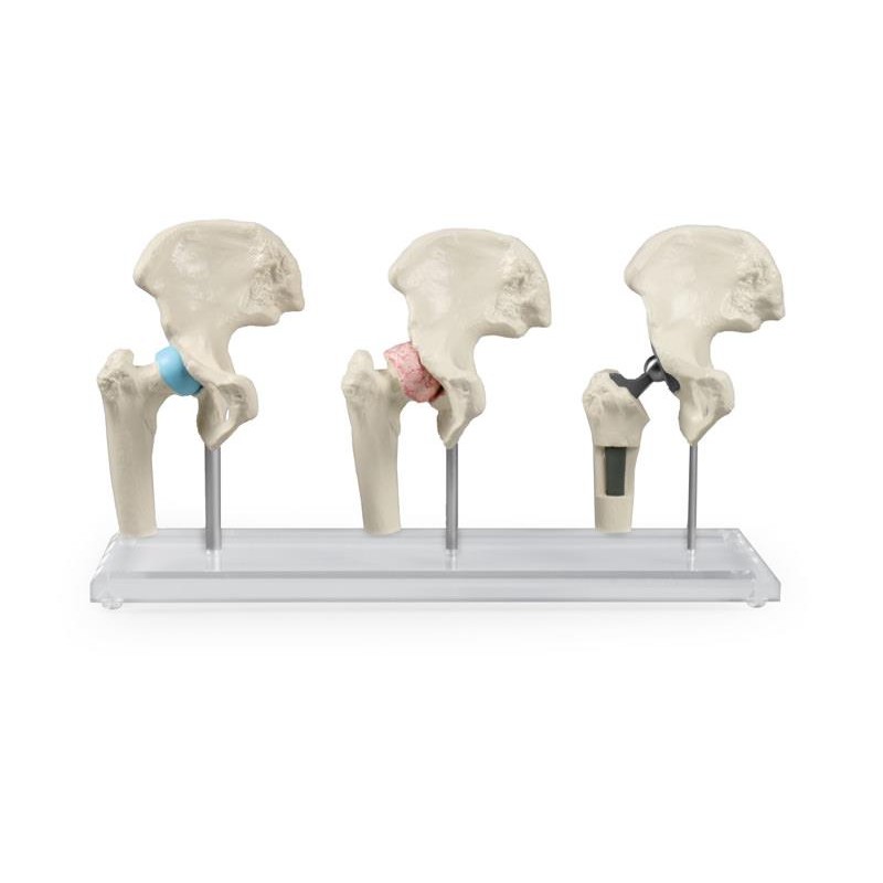 Hip Implant Model